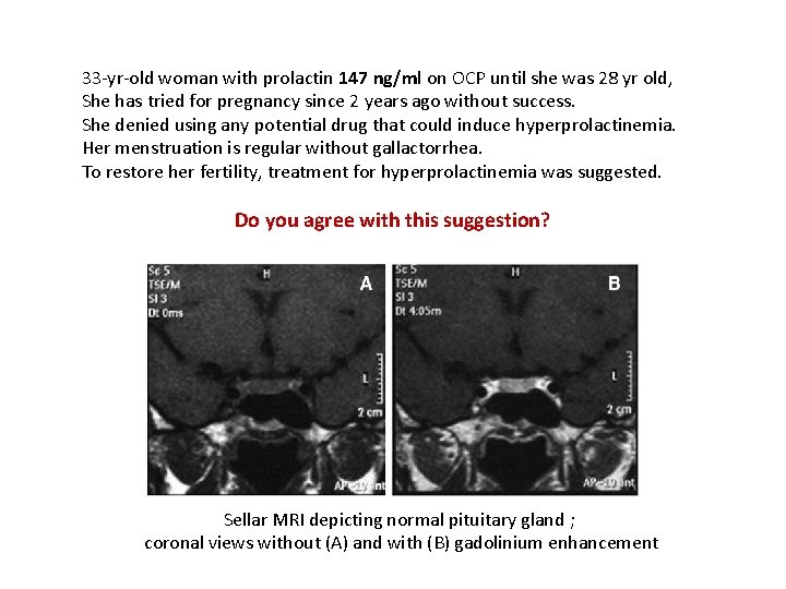 33 -yr-old woman with prolactin 147 ng/ml on OCP until she was 28 yr