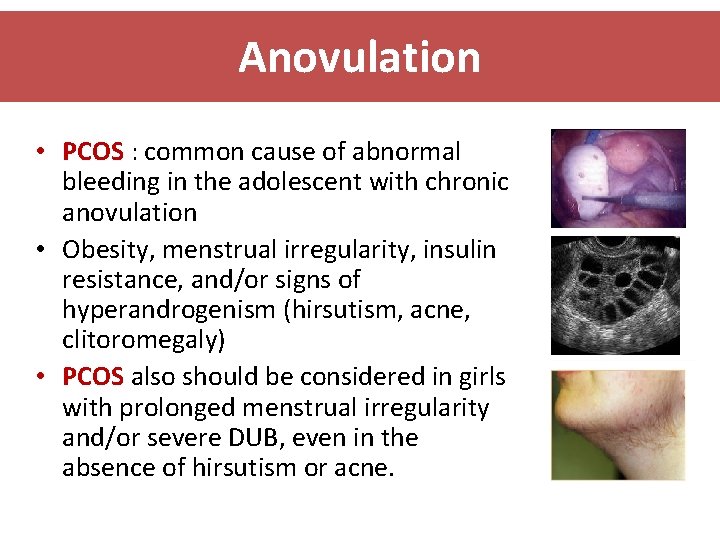 Anovulation • PCOS : common cause of abnormal bleeding in the adolescent with chronic