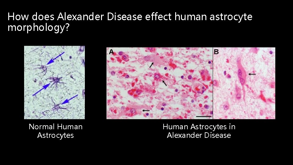 How does Alexander Disease effect human astrocyte morphology? Normal Human Astrocytes in Alexander Disease
