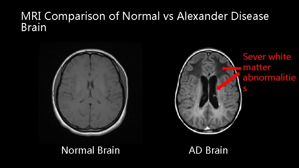MRI Comparison of Normal vs Alexander Disease Brain Sever white matter abnormalitie s Normal