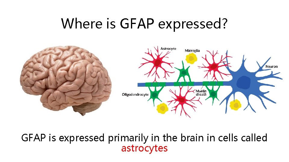 Where is GFAP expressed? GFAP is expressed primarily in the brain in cells called