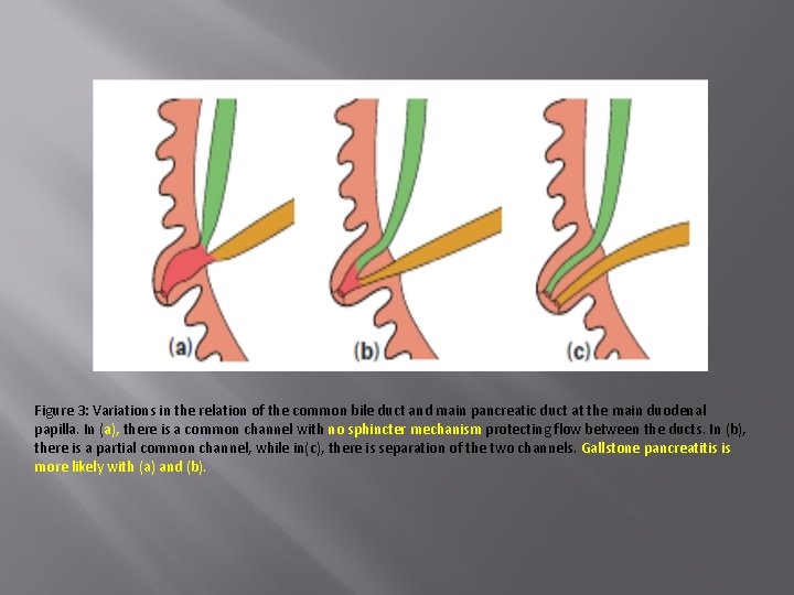 Figure 3: Variations in the relation of the common bile duct and main pancreatic