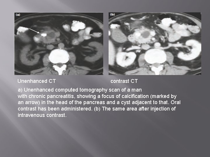 Unenhanced CT contrast CT a) Unenhanced computed tomography scan of a man with chronic