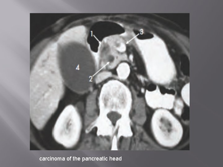 carcinoma of the pancreatic head 