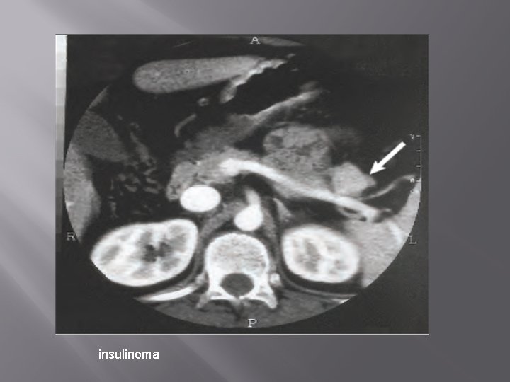 insulinoma 