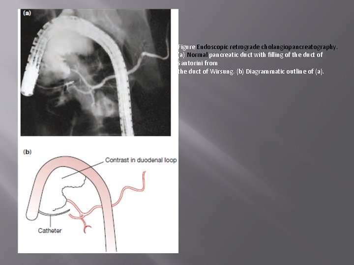 Figure Endoscopic retrograde cholangiopancreatography. (a) Normal pancreatic duct with filling of the duct of
