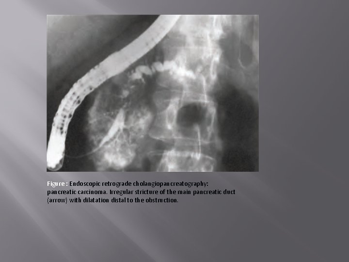 Figure : Endoscopic retrograde cholangiopancreatography: pancreatic carcinoma. Irregular stricture of the main pancreatic duct