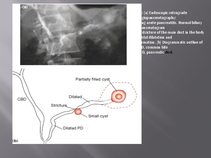 Figure : (a) Endoscopic retrograde cholangiopancreatography: relapsing acute pancreatitis. Normal biliary tree. Pancreatogram shows