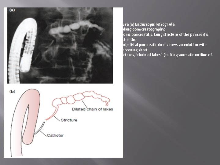 Figure (a) Endoscopic retrograde cholangiopancreatography: chronic pancreatitis. Long stricture of the pancreatic duct in