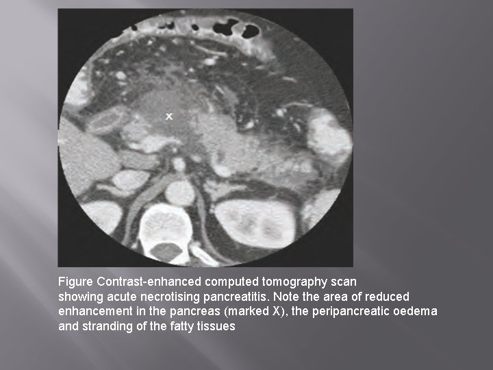 Figure Contrast-enhanced computed tomography scan showing acute necrotising pancreatitis. Note the area of reduced