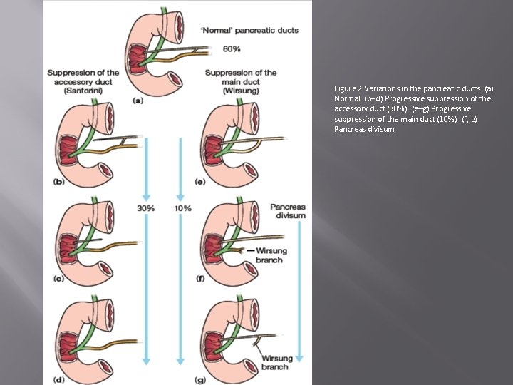 Figure 2 Variations in the pancreatic ducts. (a) Normal. (b–d) Progressive suppression of the