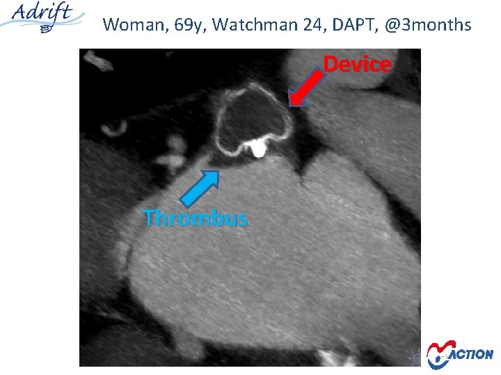 Woman, 69 y, Watchman 24, DAPT, @3 months Device Thrombus 