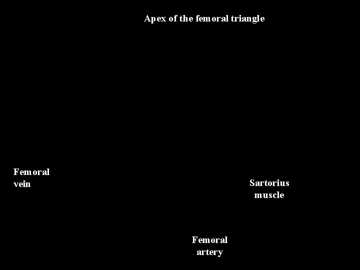 Apex of the femoral triangle Femoral vein Sartorius muscle Femoral artery 