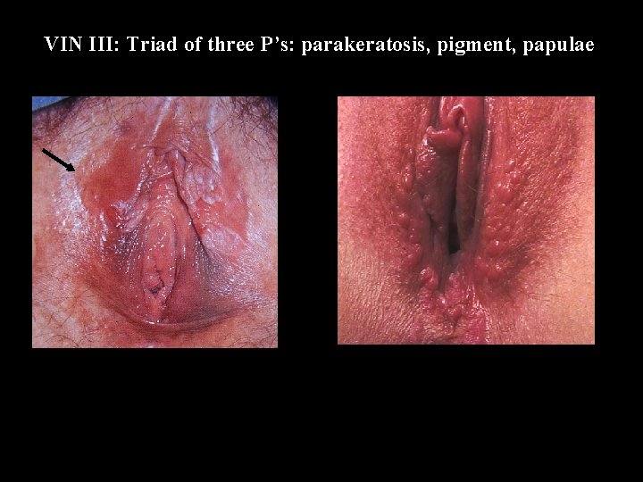 VIN III: Triad of three P’s: parakeratosis, pigment, papulae 