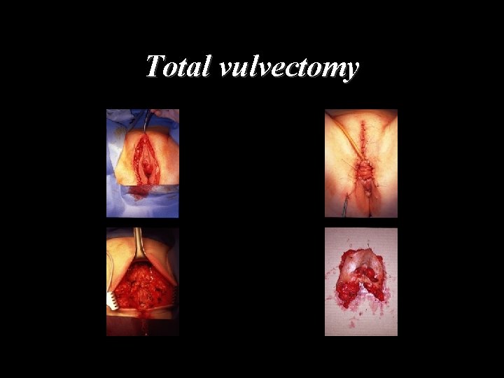 Total vulvectomy 