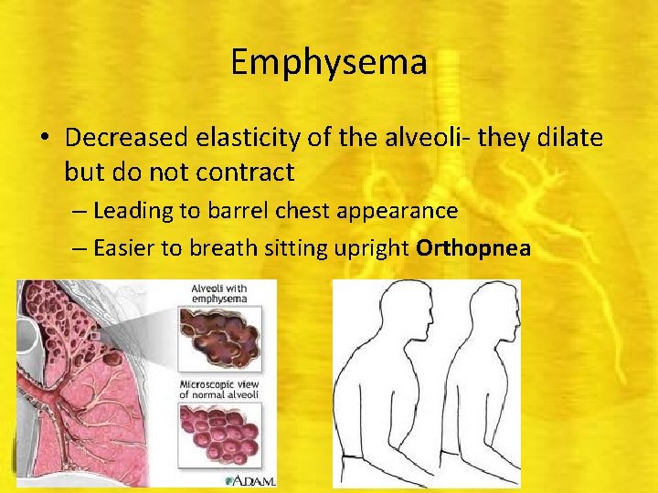 Emphysema • Decreased elasticity of the alveoli- they dilate but do not contract –