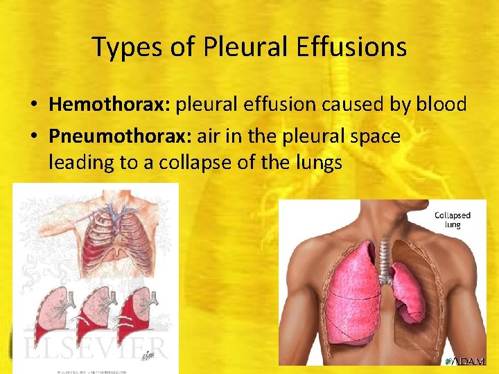 Types of Pleural Effusions • Hemothorax: pleural effusion caused by blood • Pneumothorax: air