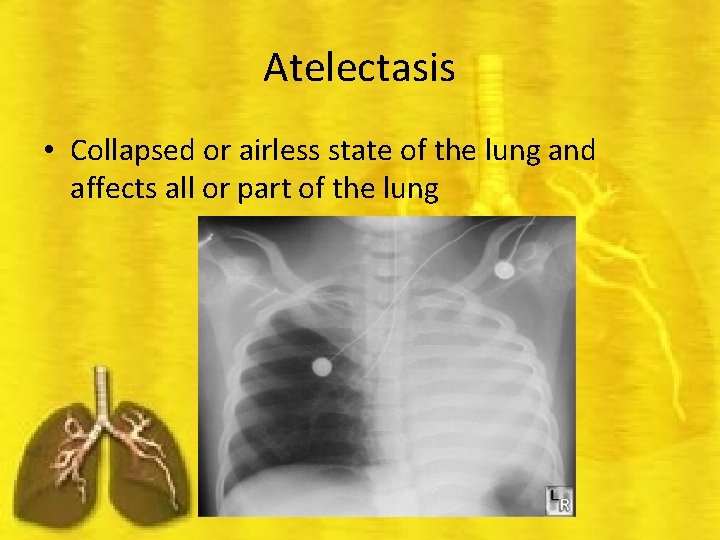 Atelectasis • Collapsed or airless state of the lung and affects all or part