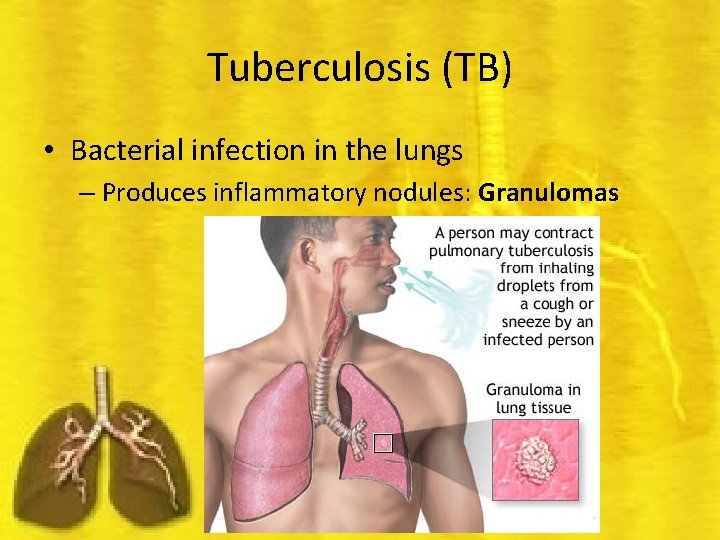 Tuberculosis (TB) • Bacterial infection in the lungs – Produces inflammatory nodules: Granulomas 