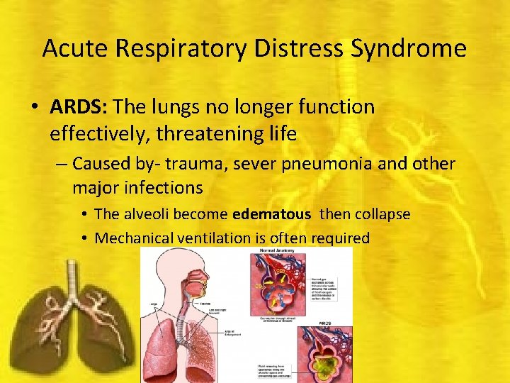 Acute Respiratory Distress Syndrome • ARDS: The lungs no longer function effectively, threatening life