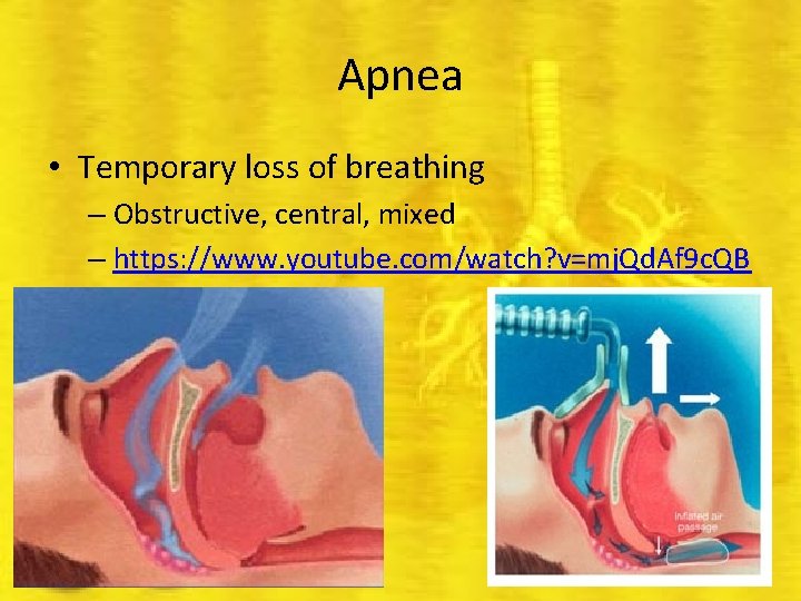 Apnea • Temporary loss of breathing – Obstructive, central, mixed – https: //www. youtube.