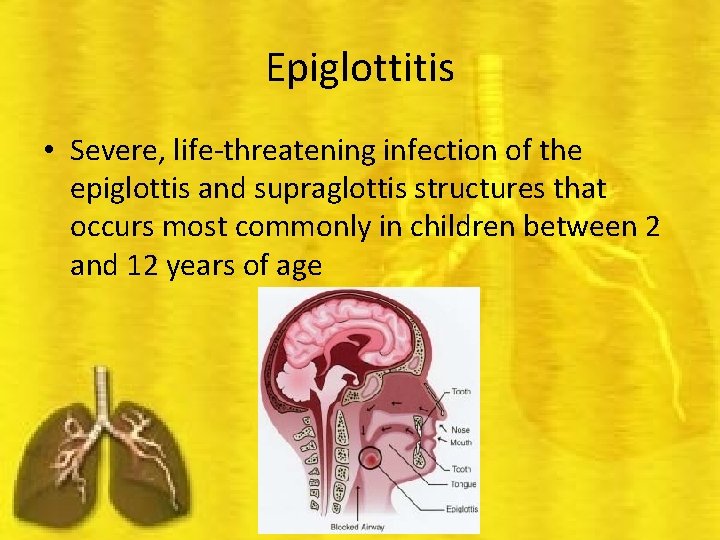 Epiglottitis • Severe, life-threatening infection of the epiglottis and supraglottis structures that occurs most