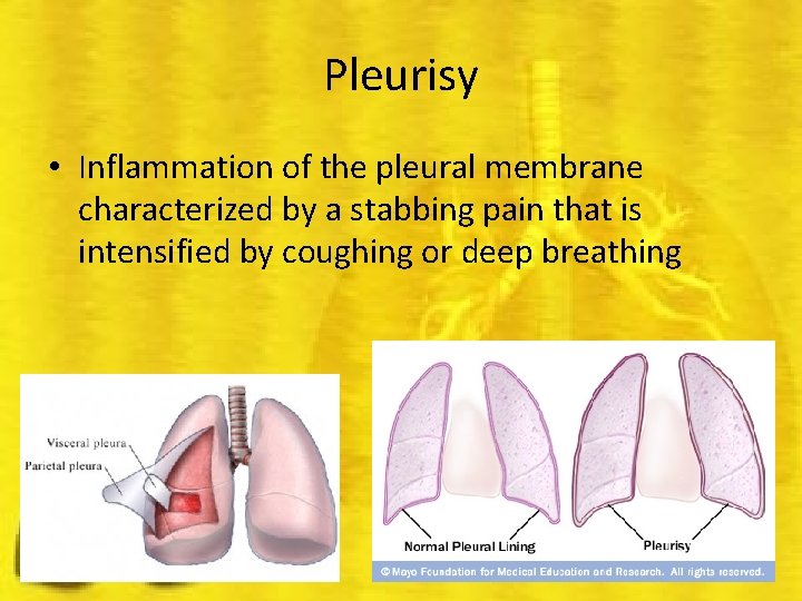 Pleurisy • Inflammation of the pleural membrane characterized by a stabbing pain that is