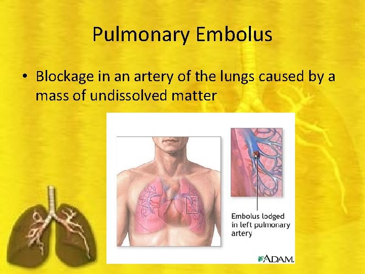 Pulmonary Embolus • Blockage in an artery of the lungs caused by a mass