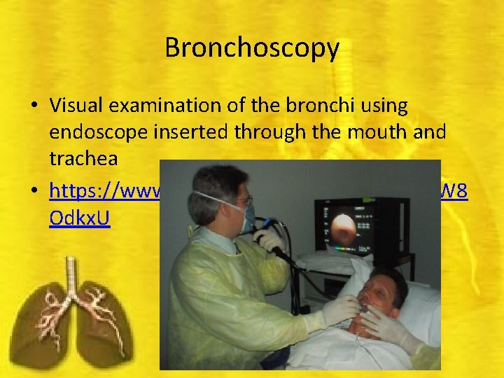 Bronchoscopy • Visual examination of the bronchi using endoscope inserted through the mouth and