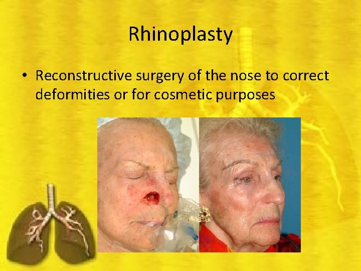 Rhinoplasty • Reconstructive surgery of the nose to correct deformities or for cosmetic purposes