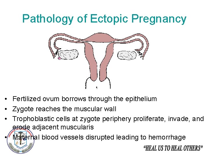 Pathology of Ectopic Pregnancy • Fertilized ovum borrows through the epithelium • Zygote reaches