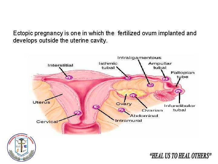 Ectopic pregnancy is one in which the fertilized ovum implanted and develops outside the