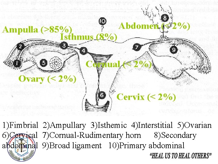 SITES OF ECTOPIC PREGNANCY Abdomen (< 2%) Ampulla (>85%) Isthmus (8%) Cornual (< 2%)