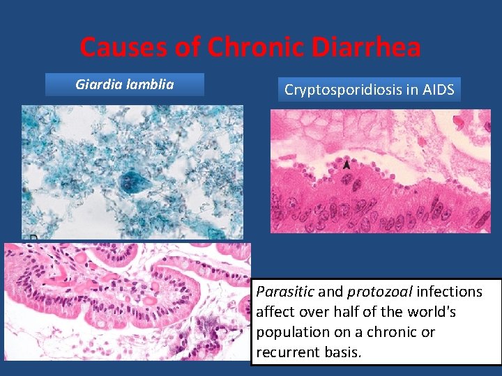 Causes of Chronic Diarrhea Giardia lamblia Cryptosporidiosis in AIDS Parasitic and protozoal infections affect