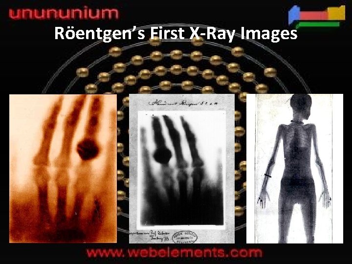 Röentgen’s First X-Ray Images 