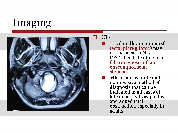 Imaging o CTn Focal midbrain tumours( tectal plate glioma) may not be seen on