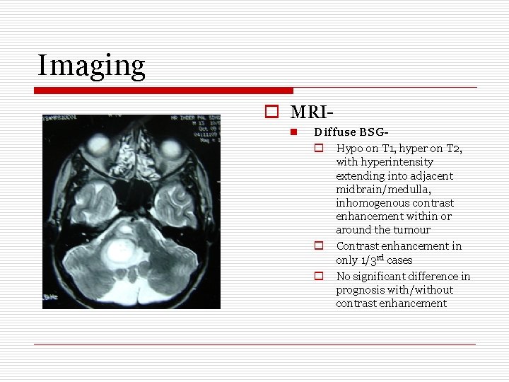 Imaging o MRIn Diffuse BSGo Hypo on T 1, hyper on T 2, with