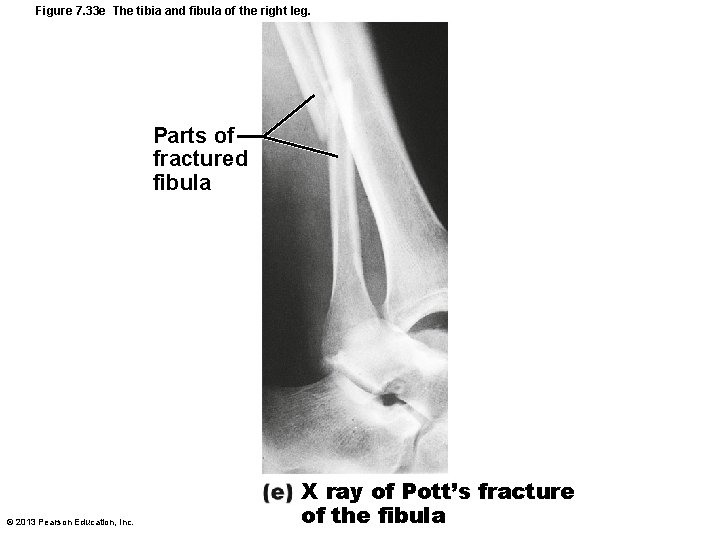 Figure 7. 33 e The tibia and fibula of the right leg. Parts of