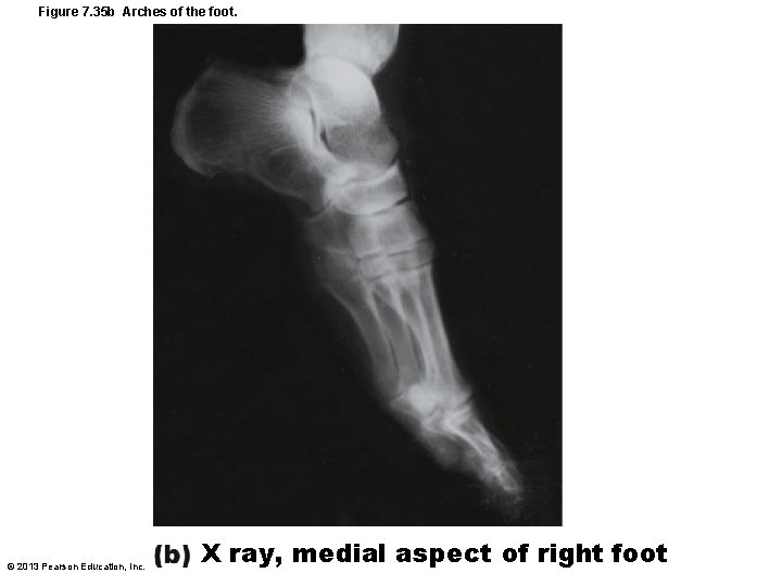 Figure 7. 35 b Arches of the foot. © 2013 Pearson Education, Inc. X