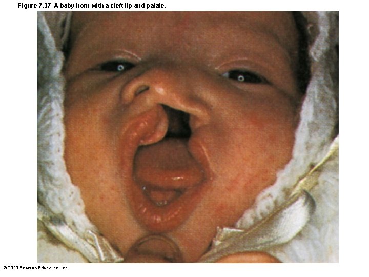 Figure 7. 37 A baby born with a cleft lip and palate. © 2013