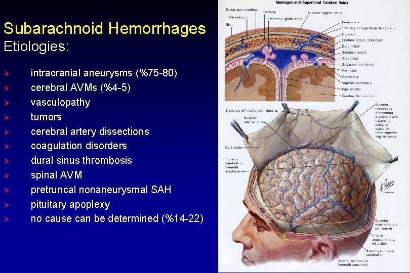 Subarachnoid Hemorrhages Etiologies: Ø Ø Ø intracranial aneurysms (%75 -80) cerebral AVMs (%4 -5)
