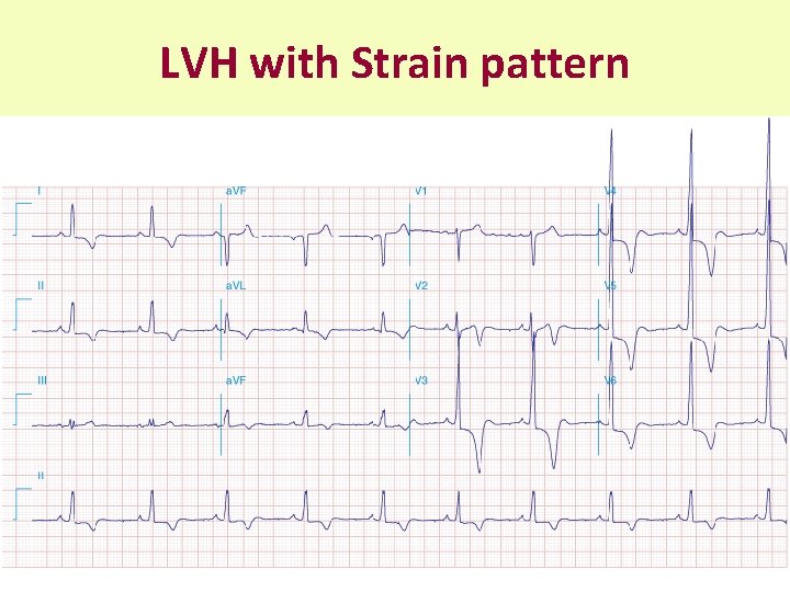 LVH with Strain pattern 