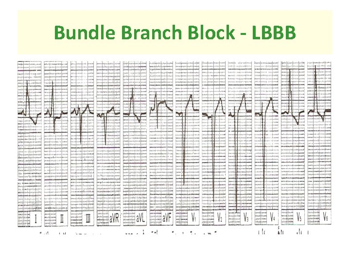 Bundle Branch Block - LBBB 