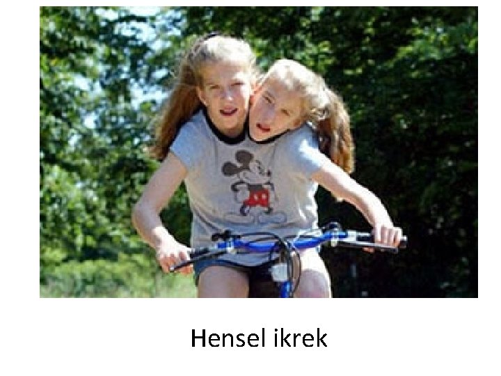 Hensel ikrek 