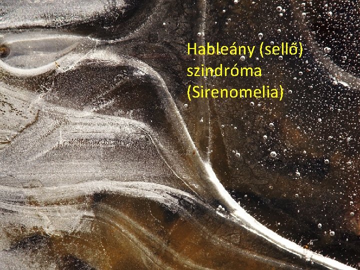 Hableány (sellő) szindróma (Sirenomelia) 