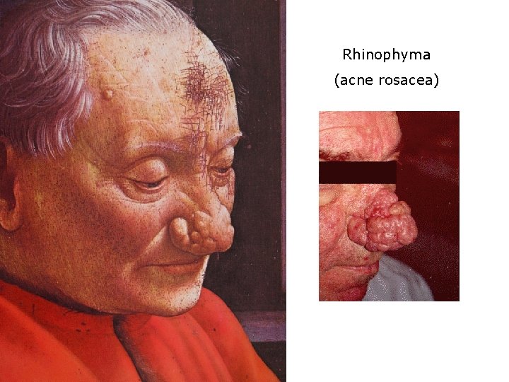 Rhinophyma (acne rosacea) 