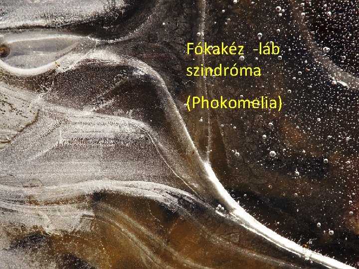 Fókakéz -láb szindróma (Phokomelia) 