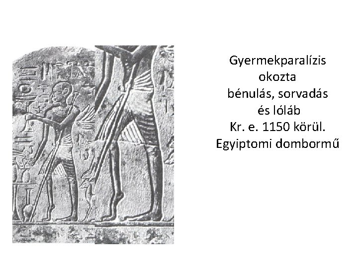 Gyermekparalízis okozta bénulás, sorvadás és lóláb Kr. e. 1150 körül. Egyiptomi dombormű 
