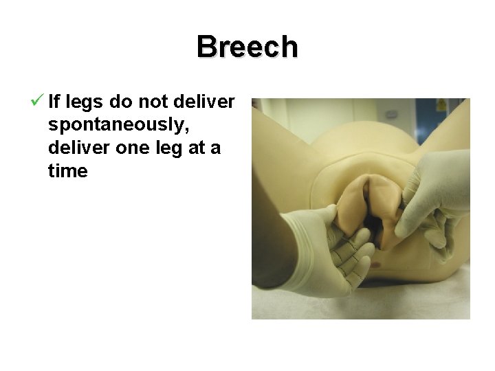 Breech ü If legs do not deliver spontaneously, deliver one leg at a time