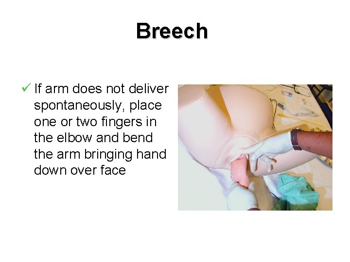 Breech ü If arm does not deliver spontaneously, place one or two fingers in